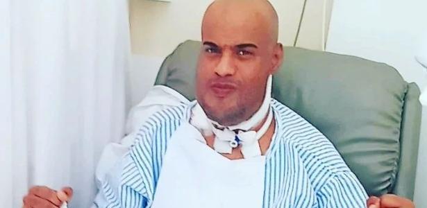 Câncer tirou minha língua e médicos reconstruíram com músculo da coxa